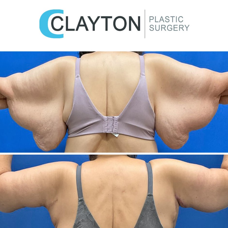 Brachioplasty Arm Lift by Dr. 